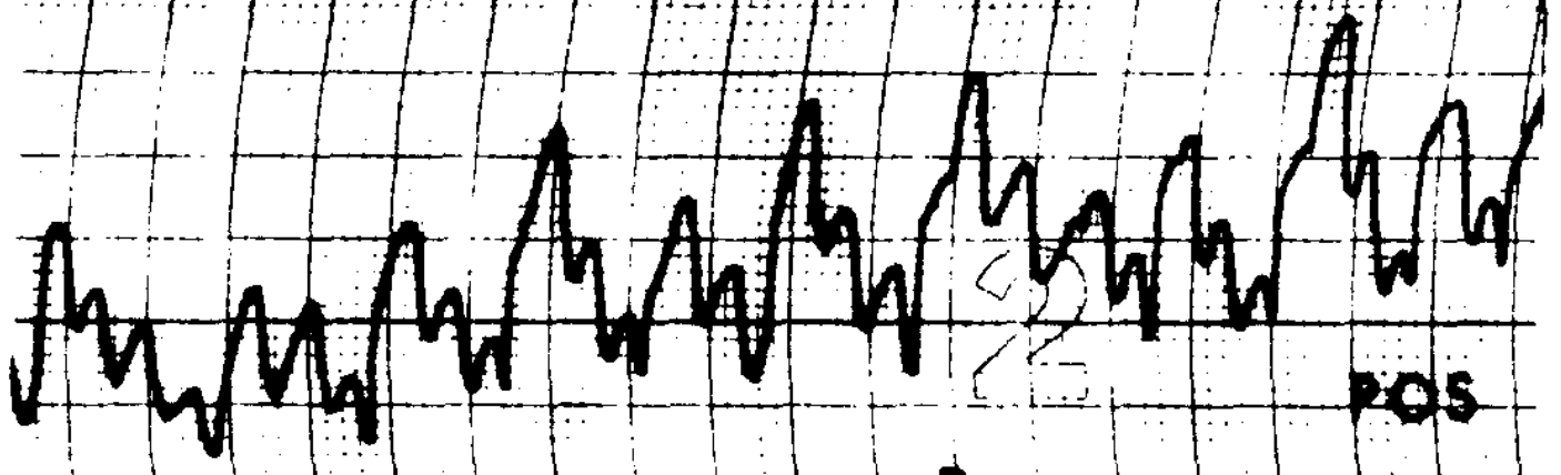 Figure: Congenital nystagmus.  Dual jerk nystagmus.  From Dell'Osso and Daroff (1975).
