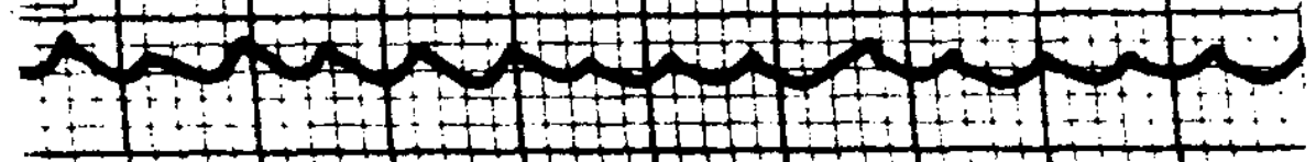 Figure: Congenital nystagmus.  Pseudo-cycloid nystagmus.  From Dell'Osso and Daroff (1975).