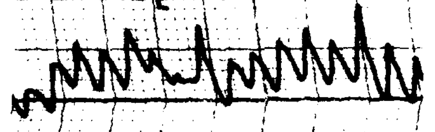 Figure: Congenital nystagmus.  Pseudo-jerk nystagmus.  From Dell'Osso and Daroff (1975).
