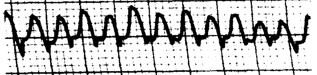 Figure: Congenital nystagmus.  Pseudo-pendular nystagmus with foveating saccades.  From Dell'Osso and Daroff (1975).