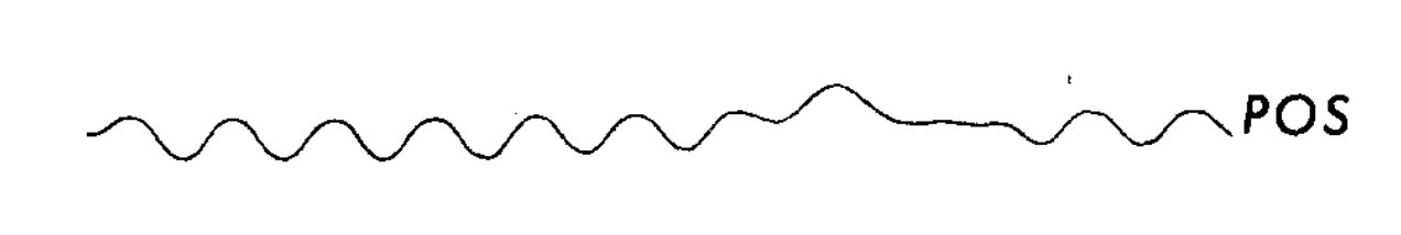 Figure: Congenital nystagmus.  Pure pendular nystagmus.  From Dell'Osso and Daroff (1975).