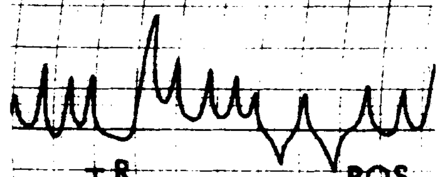 Figure: Congenital nystagmus.  Triangular nystagmus.  From Dell'Osso and Daroff (1975).