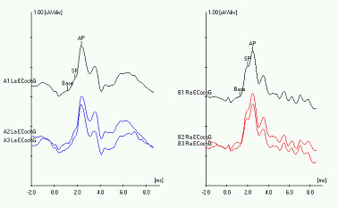 Figure: Electrocochleography showing a normal response on the left ear (left panel, blue tracing), and an elevated SP/AP ratio on the right ear (right panel, red tracing).  From http://www.dizziness-and-balance.com/testing/ecog.html (accessed 2/5/2016).