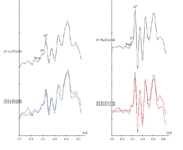 Figure: Example tracings from electrocochleography.  From http://www.dizziness-and-balance.com/testing/ecog.html (accessed 2/5/2016).