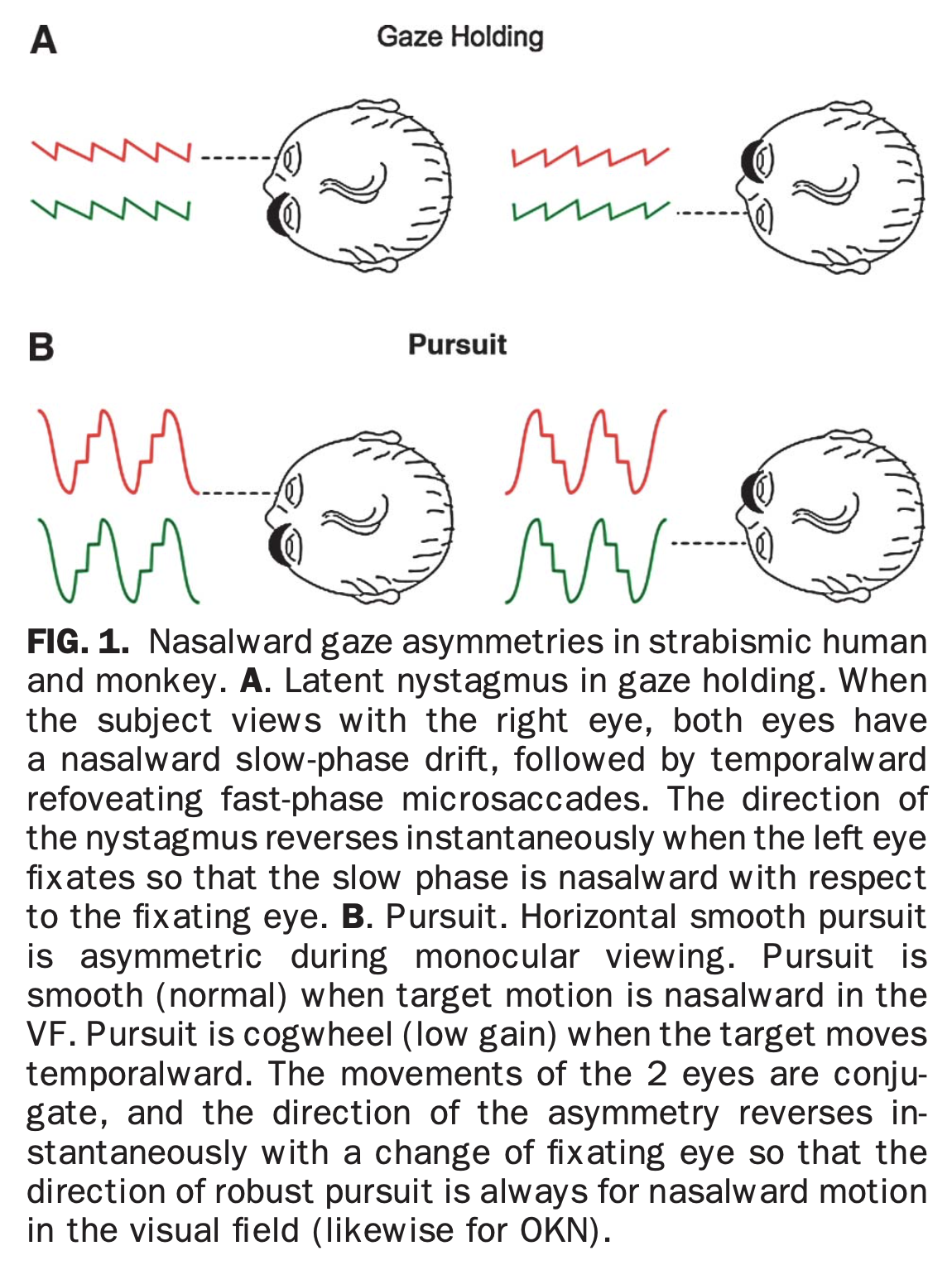 Figure: Fixed gaze (panel A) and smooth pursuit (panel B) with monocular viewing in a patient with latent nystagmus.  From Tychsen et al. (2010).
