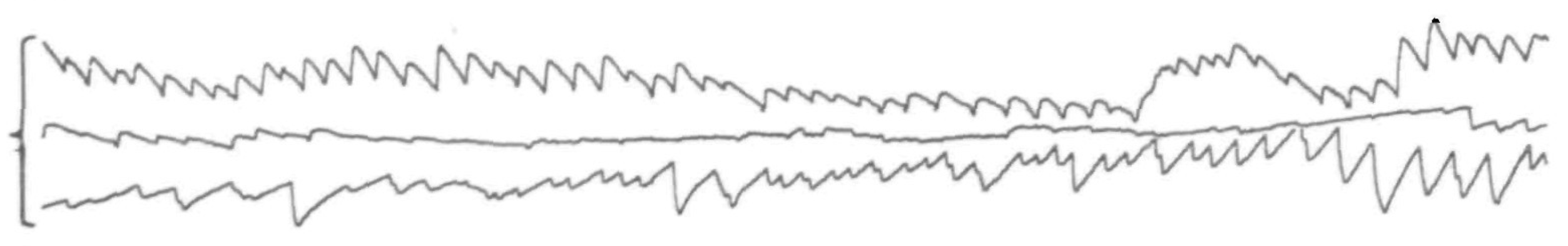 Figure: Horizontal eye movement tracing showing periodic alternating nystagmus (PAN).  From Baloh et al. (1976).
