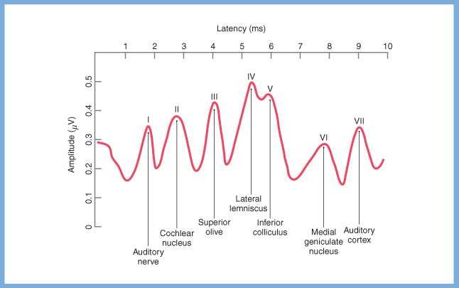 Figure: Idealized brainstem auditory evoked response, with waves corresponding to the synapses in the ascending auditory pathway.  From Haines (2006).