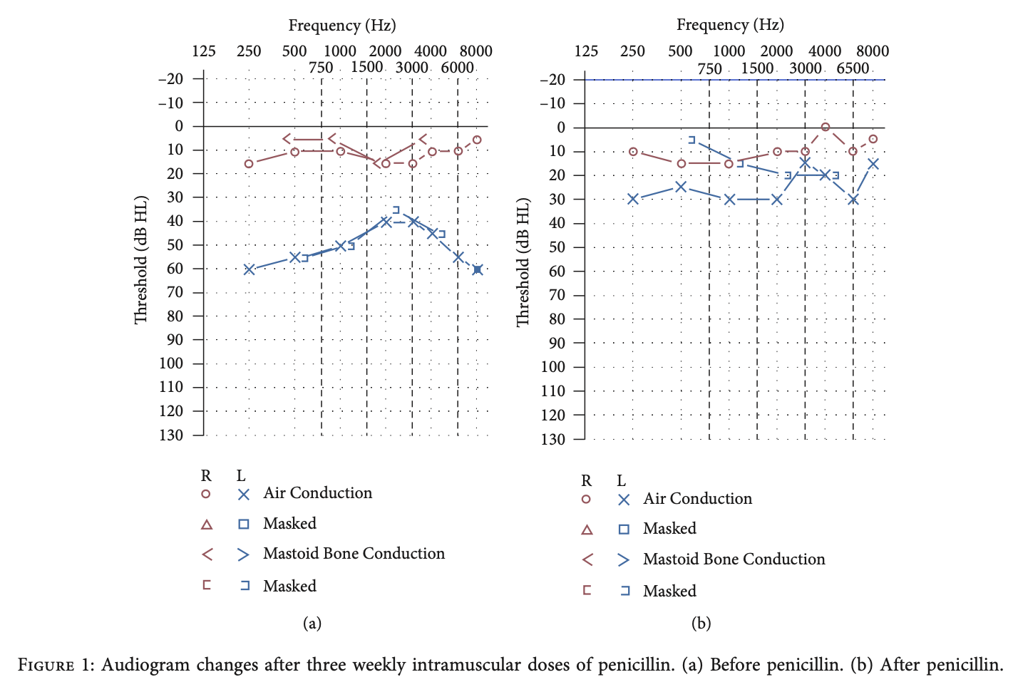 Figure: Improvement in left-sided sensorineural hearing loss on audiometry from before treatment (left panel) and after treatment (right panel).  From Etemady-Deylamy and Abate (2022).