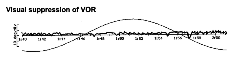 Figure: Incomplete visual suppression of the vestibulo-ocular reflex on rotatory chair testing.  From Vibert et al. (2004).