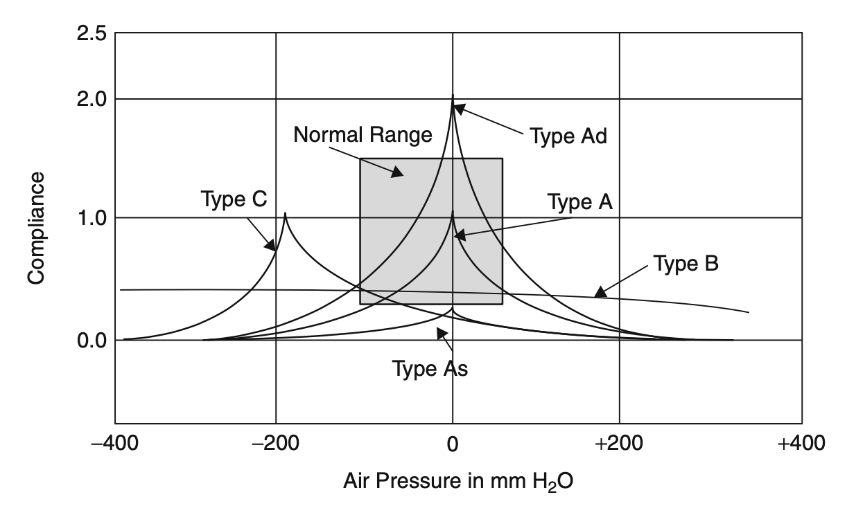 Figure: Main categories of tympanograms are shown in this composite plot from Nakayama and Ramsey (2013).