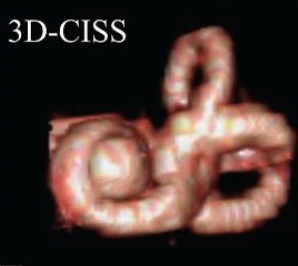 Figure: MRI of a labyrinth affected by end-lymphatic hydrops.  From http://www.annalsofian.org/viewimage.asp?img=AnnIndianAcadNeurol_2011_14_1_12_78043_f6.jpg (accessed 2/5/2016).