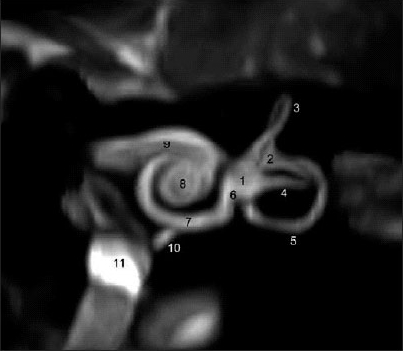 Figure: MRI of normal labyrinth.  From www.dirjournal.org/text.php3?id=127 (accessed 2/5/2016).