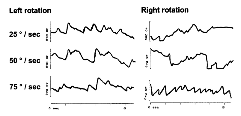 Figure: Optokinetic responses are poor in a patient with superficial siderosis.  From Vibert et al. (2004).