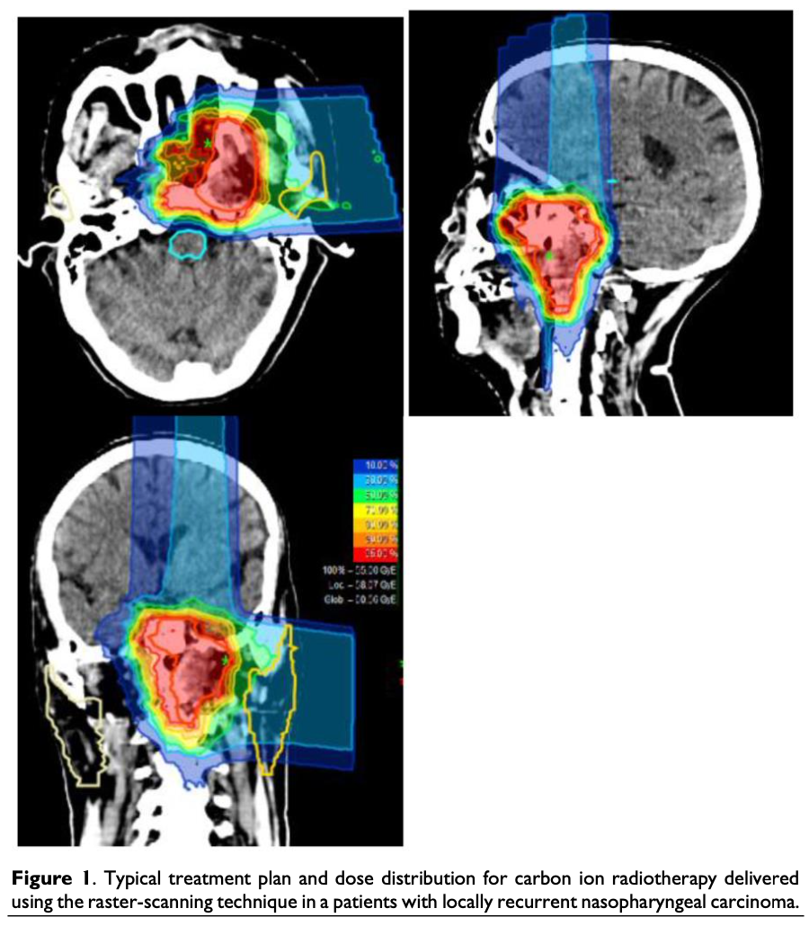 Figure: Radiation isodose lines in planning carbon ion radiotherapy for a patient with locally recurrent nasopharyngeal carcinoma.  From Kong et al. (2016).