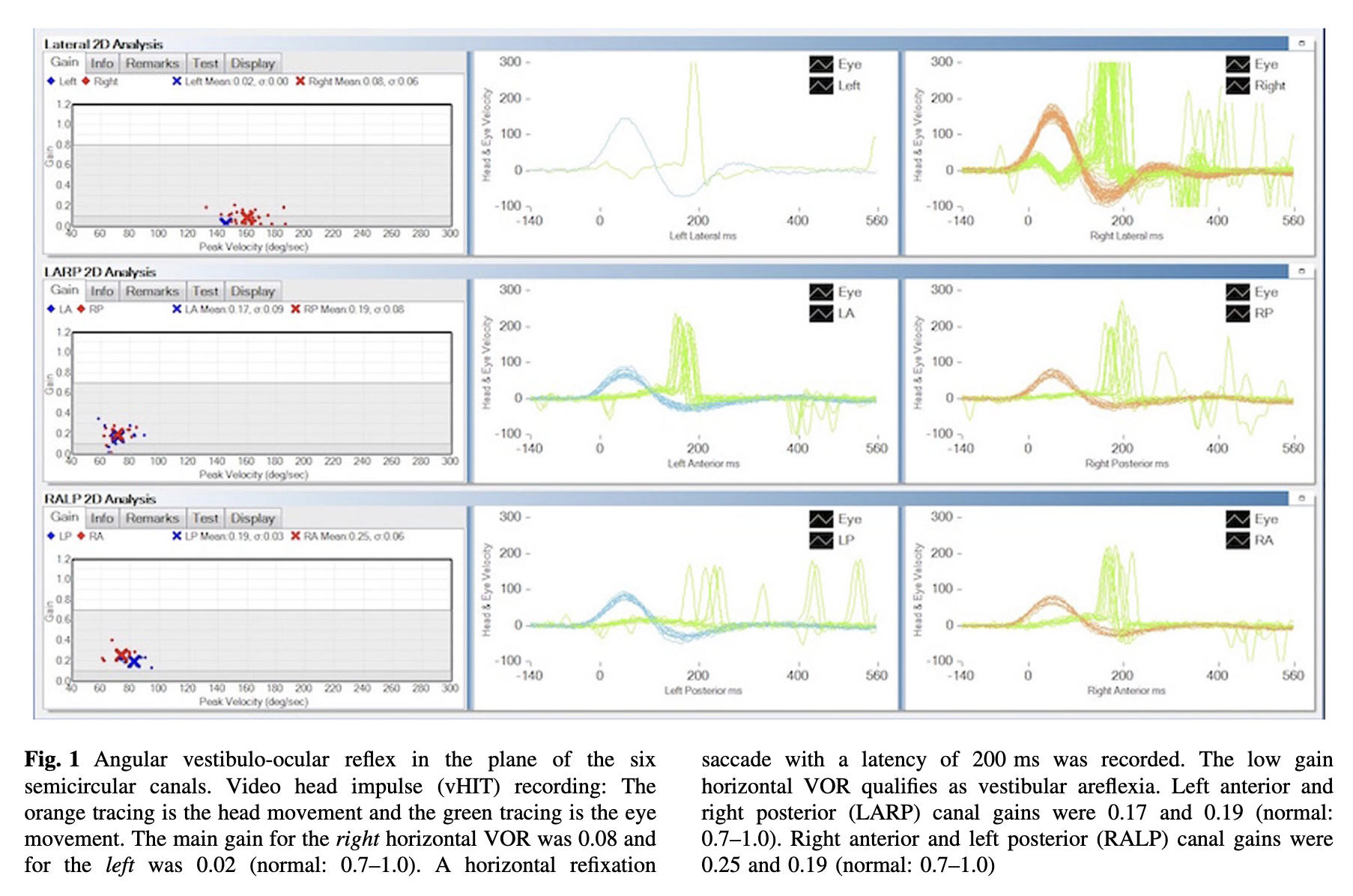 Figure: Results of video head impulse testing in a patient with superficial siderosis.  From Yoo and Kattah (2017).