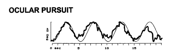 Figure: Saccadic smooth pursuit movements in a patient with superficial siderosis.  From Vibert et al. (2004).