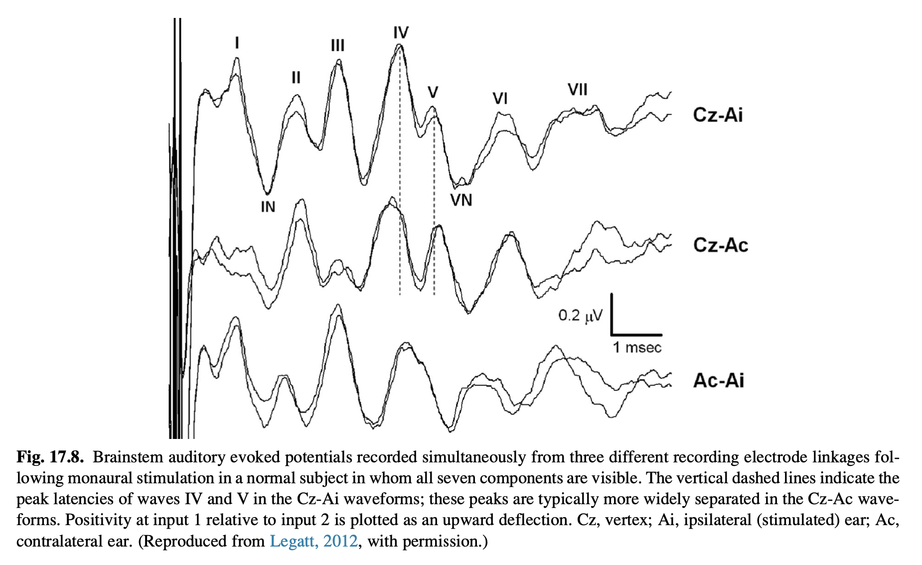 Figure: Sample ABR waveforms.  From Legatt (2012).