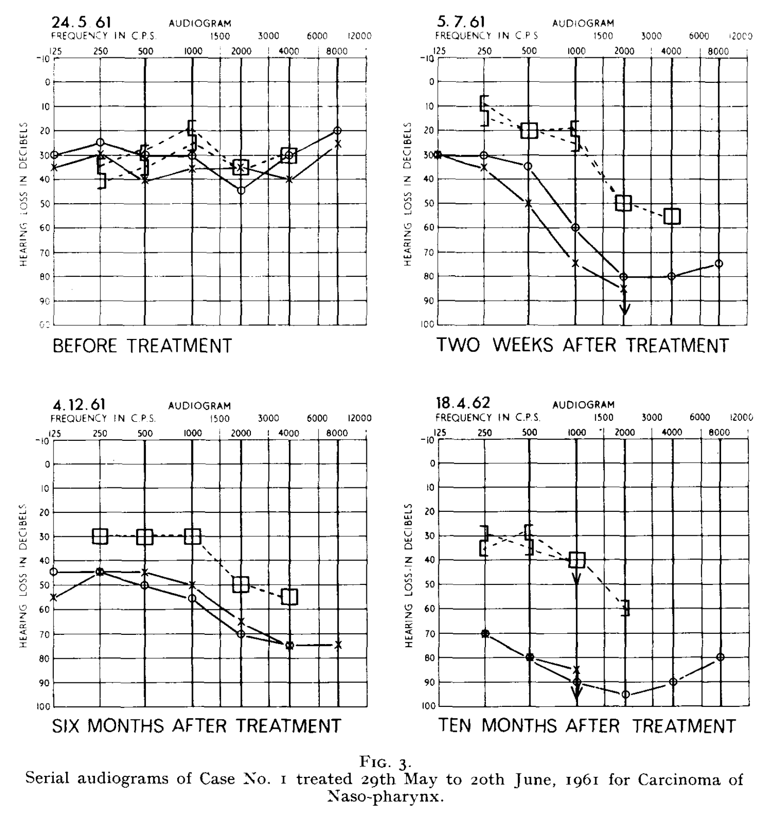 Figure: Serial audiometry from prior to radiation therapy to 10 months after radiation therapy in a patient treated for nasopharyngeal carcinoma.  From Leach (1965).