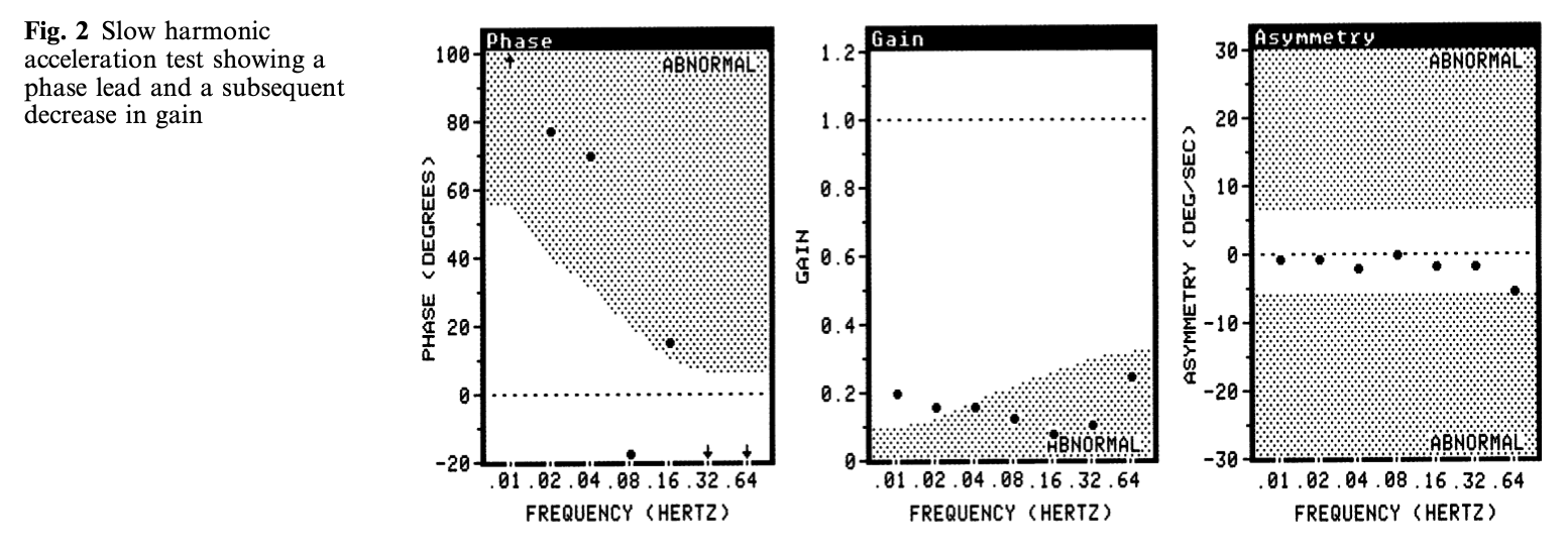 Figure: Slow harmonic acceleration in a patient with bilateral otosyphilis.  From Song et al. (2005).