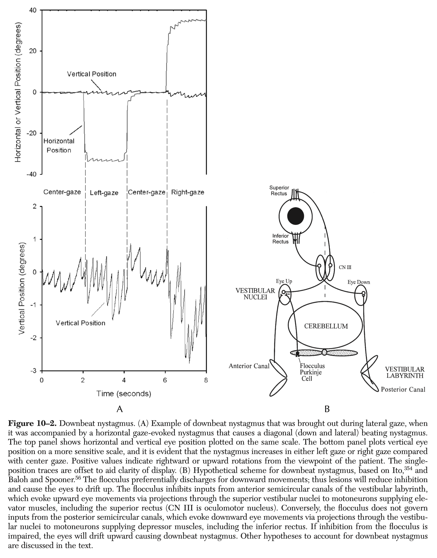 Figure: Spontaneous down beat jerk nystagmus can appear, or be augmented, at the extremes of lateral gaze.  From Leigh and Zee (2015).