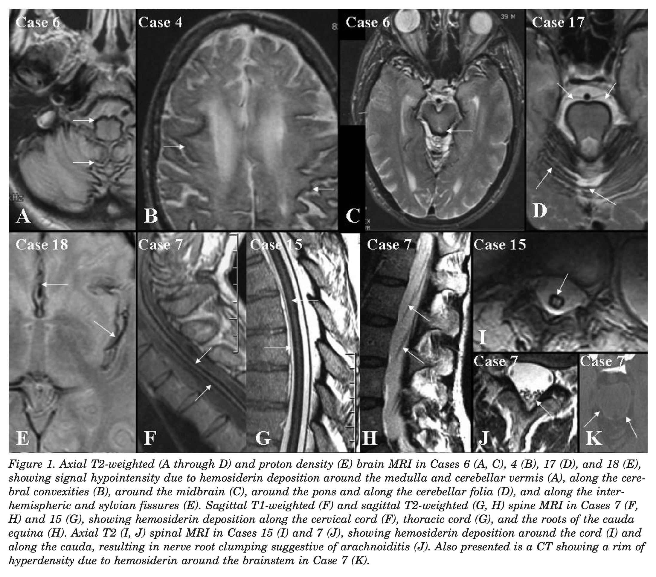 Figure: T2-weighted MRI images of the cerebrum, brainstem and spinal cord in patients with superficial siderosis.  From Kumar et al. (2006).