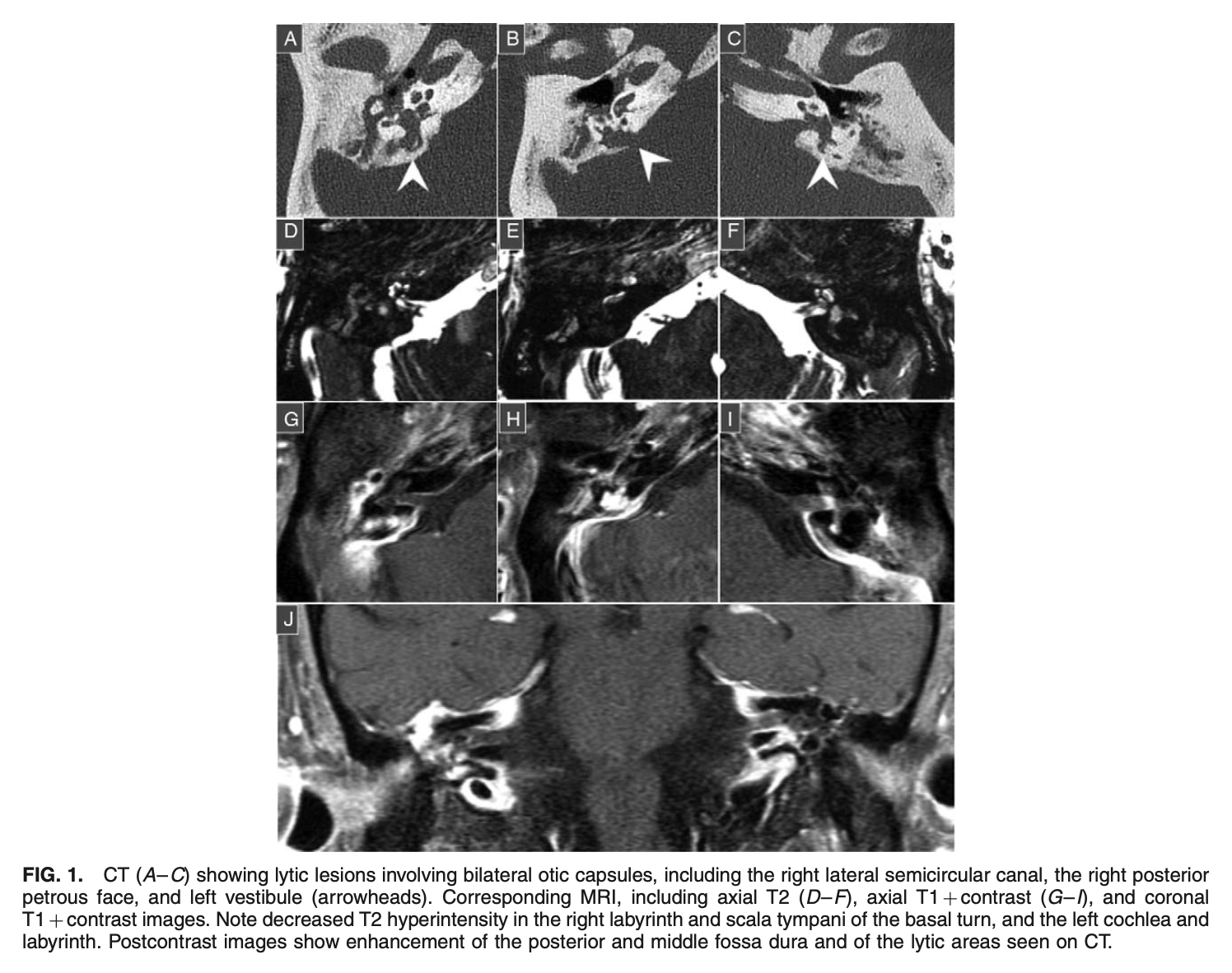 Figure: Temporal bone CT showing osteolytic lesions involving the labyrinth in a case of otosyphilis.  From Hosseini et al. (2021).