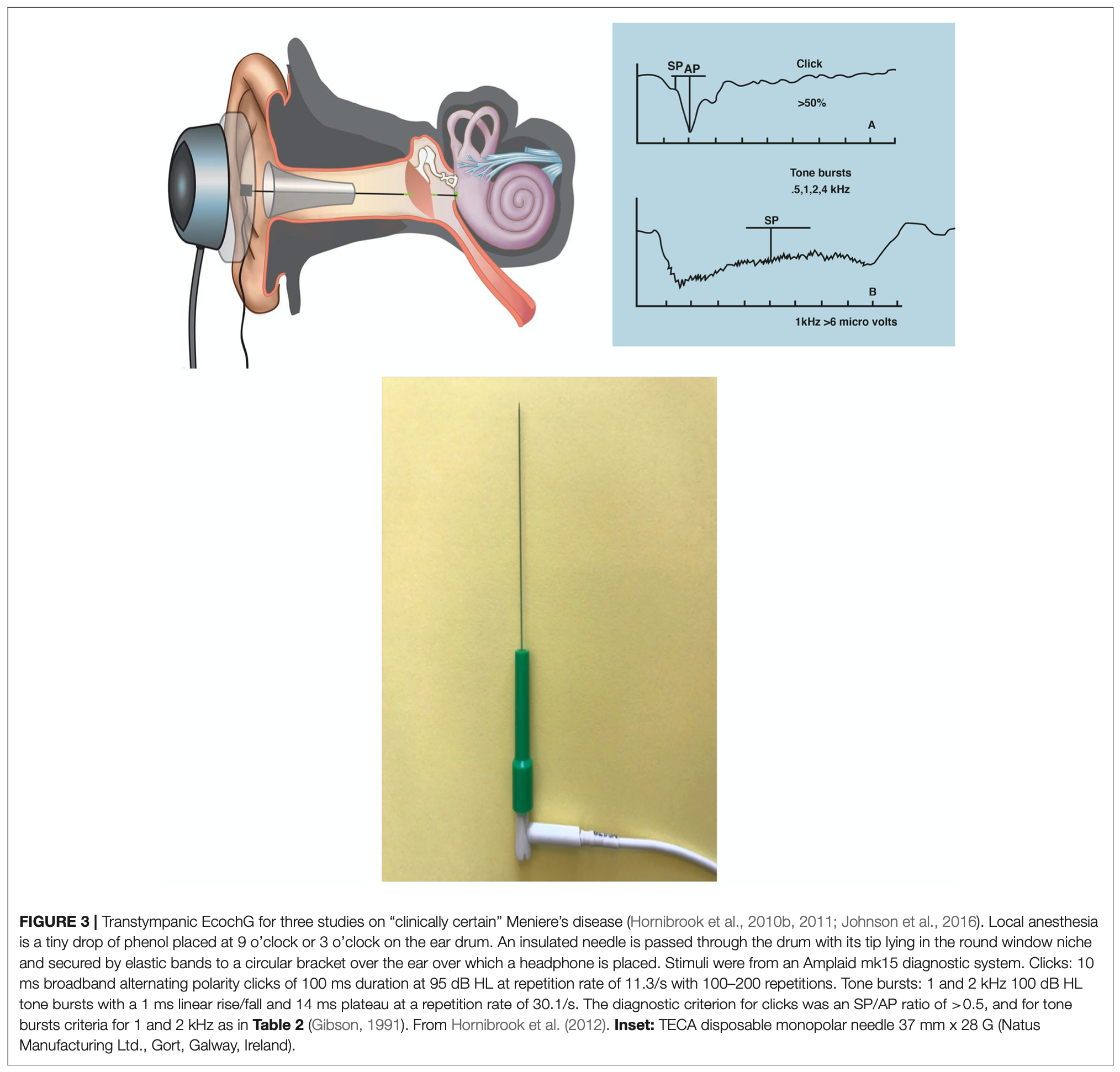 Figure: Transtympanic electrode placement for electrocochleography.  From Hornibrook (2017).