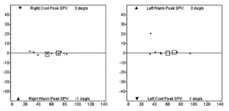 Figure: Videonystagmography in a patient with superficial siderosis shows essentially absent bilateral caloric responses.  From Choi et al. (2014).
