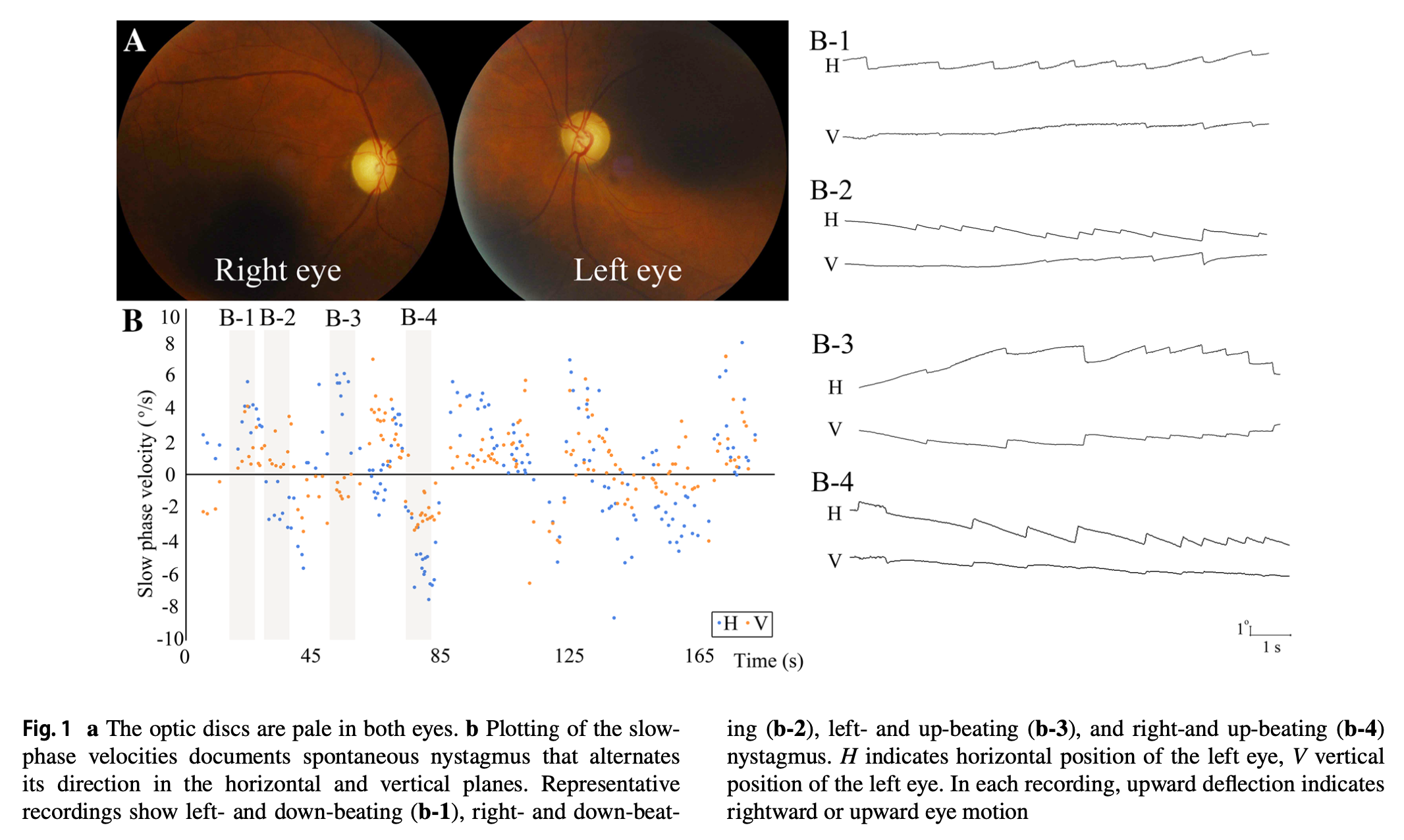 Figure: Windmill nystagmus.  The left panel shows a plot of the alternating direction and amplitude of the slow phase velocity of horizontal (blue dots) and vertical (red dots) components of nystagmus.  The right panels show tracings of the nystagmus.  From Lee et al. (2018).