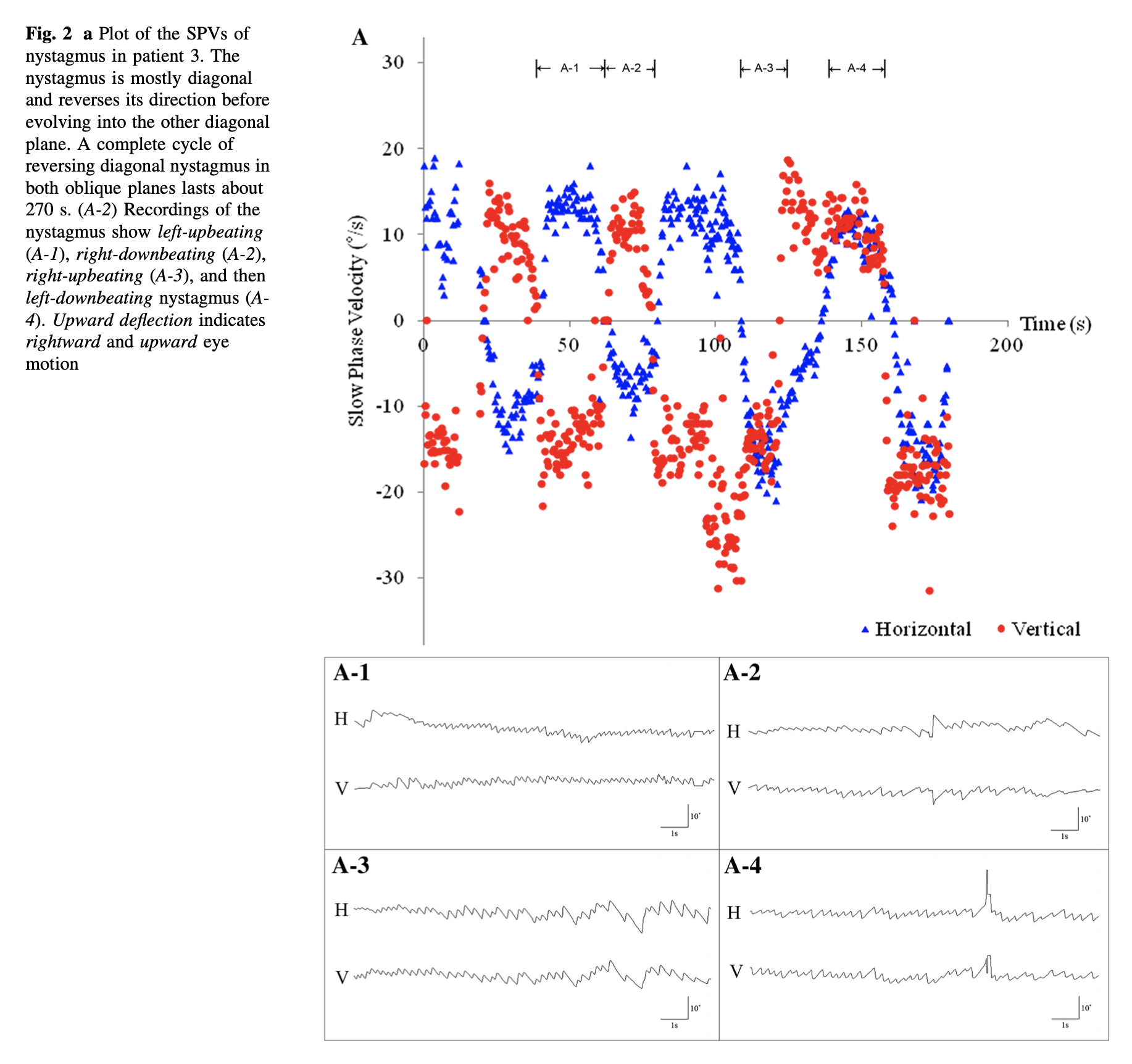 Figure: Windmill nystagmus.  The top panel shows a plot of the alternating direction and amplitude of the slow phase velocity of horizontal (blue triangles) and vertical (red circles) components of nystagmus.  The lower panel shows tracings of the nystagmus.  From Choi et al. (2016).