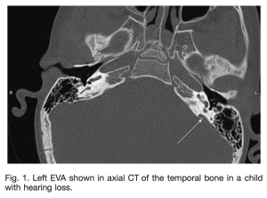 Figure: Axial CT image from a child with a large vestibular aqueduct on the patient's left. From Zhou and Gopen (2011).