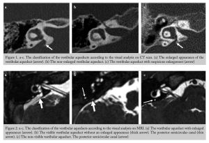 Figure: Juxtaposed CT images (top panels) and MR images (bottom panels) of the vestibular aqueduct and neighboring structures. From Sarioglu et al (2020).