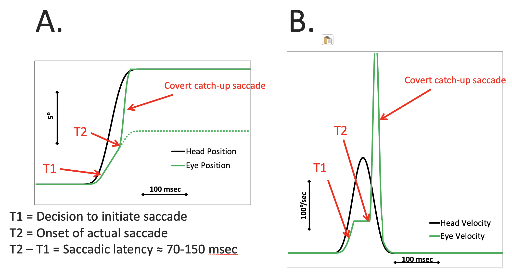 Figure: Covert corrective saccade in video head impulse testing.