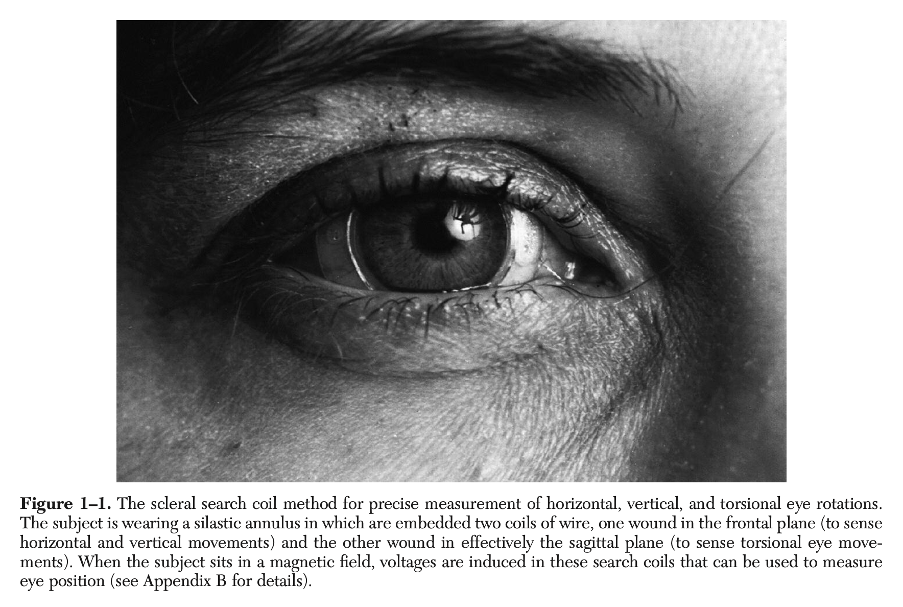 Figure: A patient wearing a magnetic scleral search coil.  From Leigh and Zee (2015).