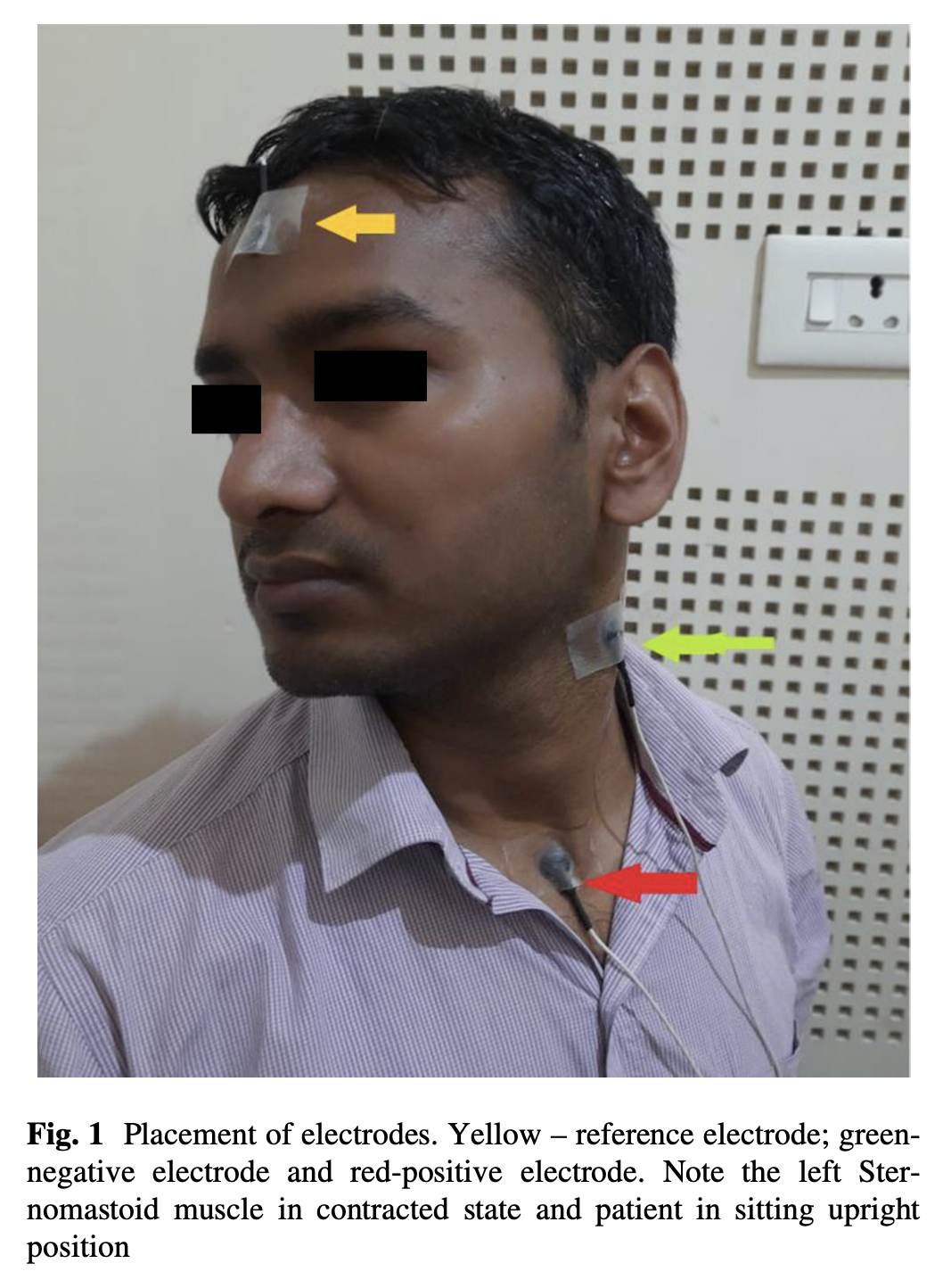 Figure: Activating the sternocleidomastoid by head turning.  From Kumar et al. (2021).