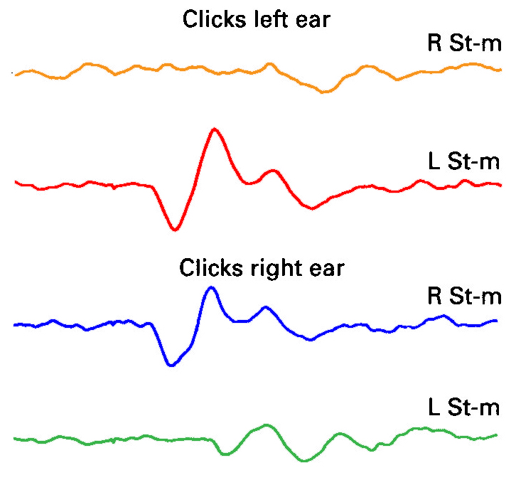 Figure: Cervical vestibular evoked myogenic potentials are larger ipsilateral to the stimulated ear than contralateral to it.  From Colebatch et al. (1994).