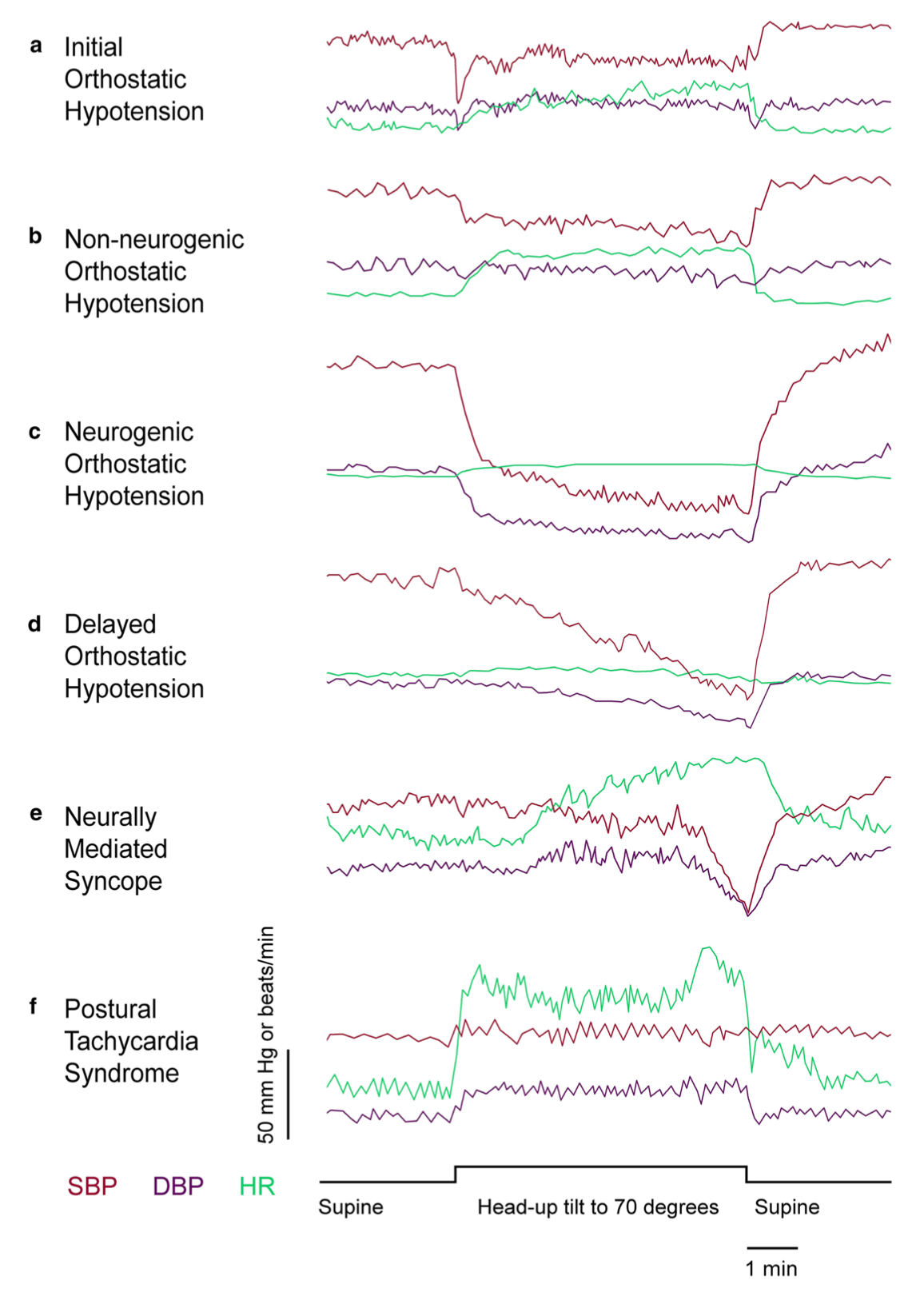 Figure: Examples of several patterns of results from tilt table testing associated with various diagnoses.  From Cheshire and Goldstein (2019).