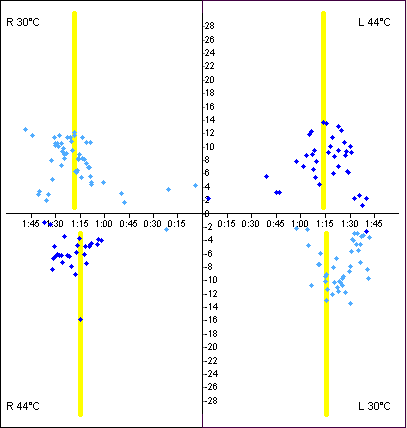 Figure: Normal butterfly diagram.