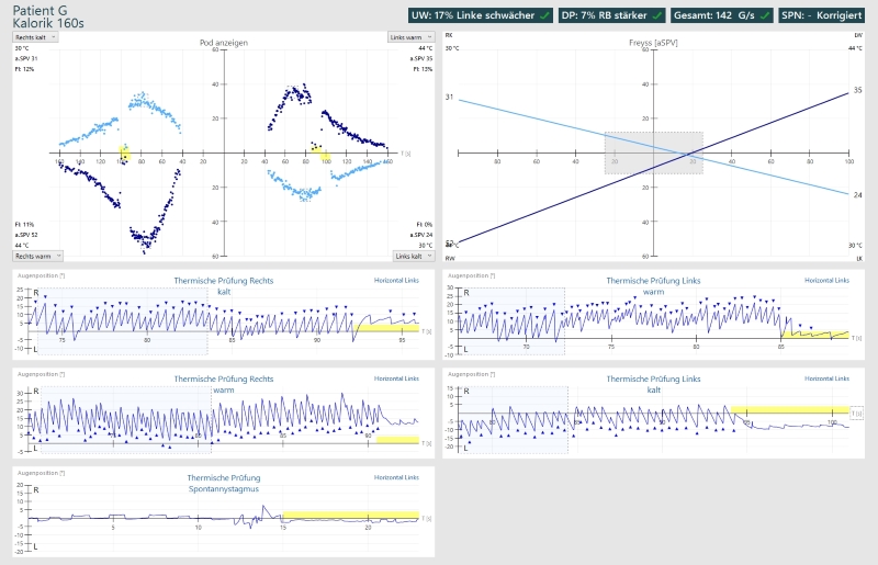 Figure: Normal caloric responses and Freyss diagram.