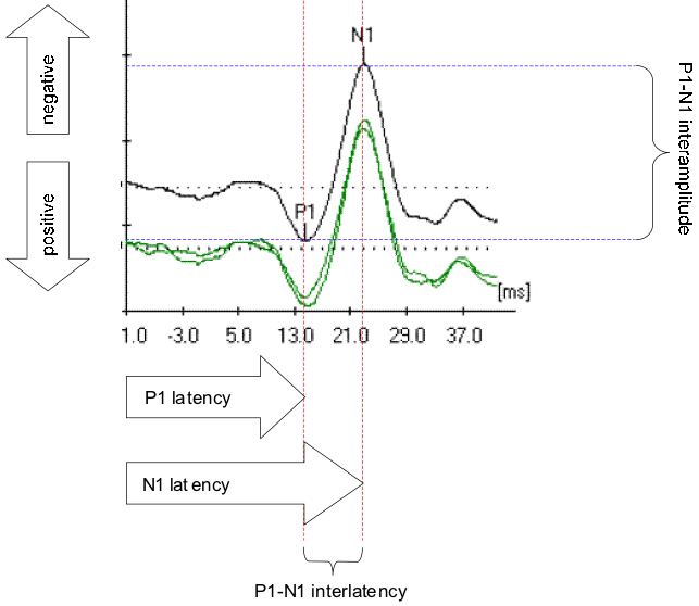 Figure: Normal cervical vestibular evoked myogenic potential.