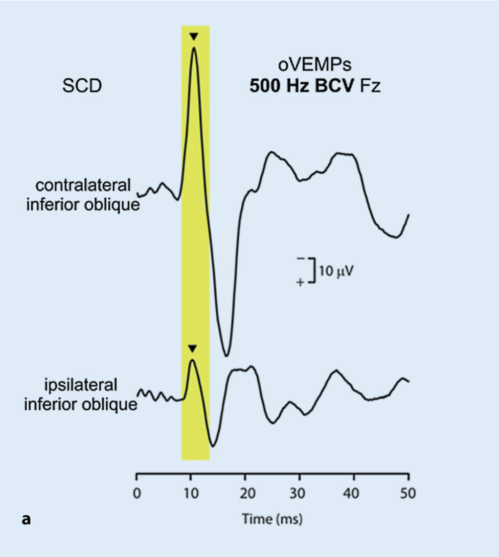 Figure: Normal ocular vestibular evoked myogenic potential.  From Dlugaiczyk (2020).