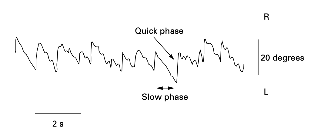 Figure: Oculographic tracing indicating quick phase and slow phase of nystagmus.  From Fatima et al. (2000).