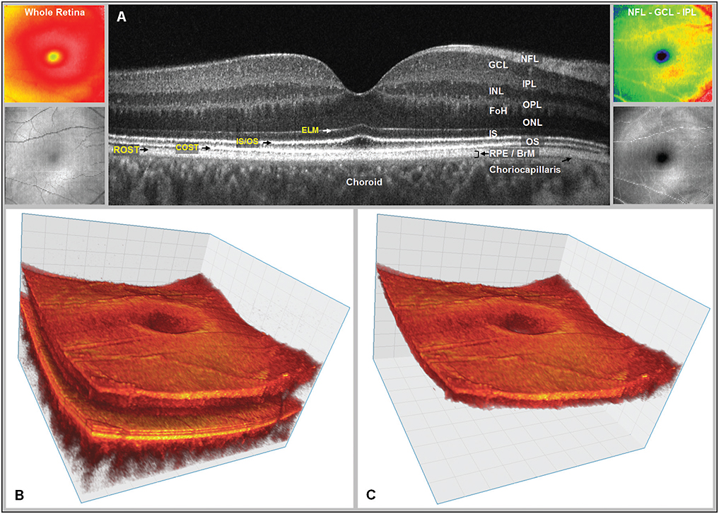 Figure: Optical coherence tomography showing the 3D morphology of the macula.  From Moisseiev et al. (2016).