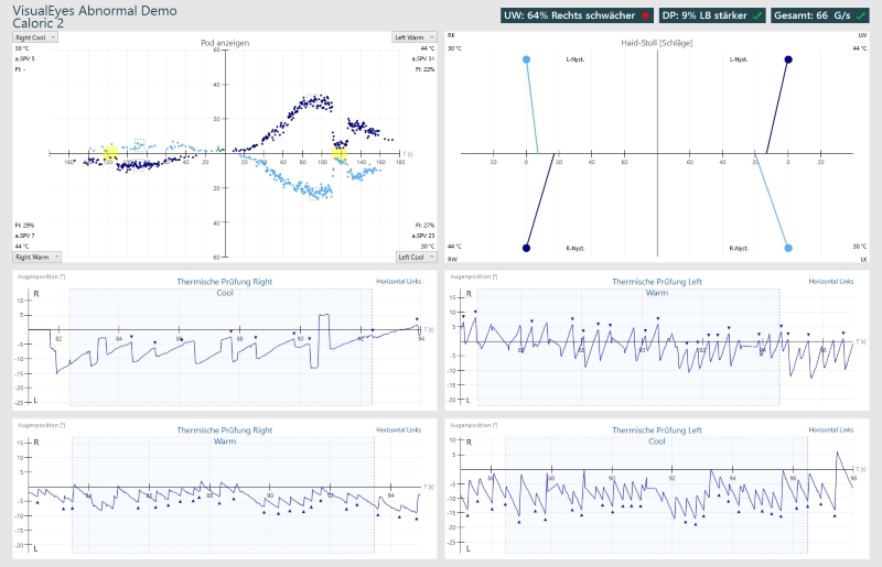 Figure: Right unilateral caloric weakness on butterfly chart (left upper panel) and corresponding Haid/Stoll diagram (right upper panel).