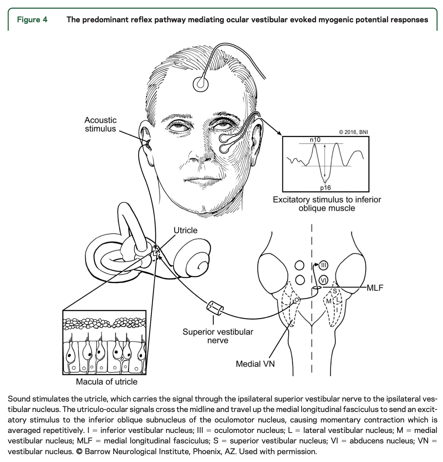 Figure: Schematic of the neuroanatomical pathway mediating the ocular vestibular evoked myogenic potential.  From Fife et al. (2017).