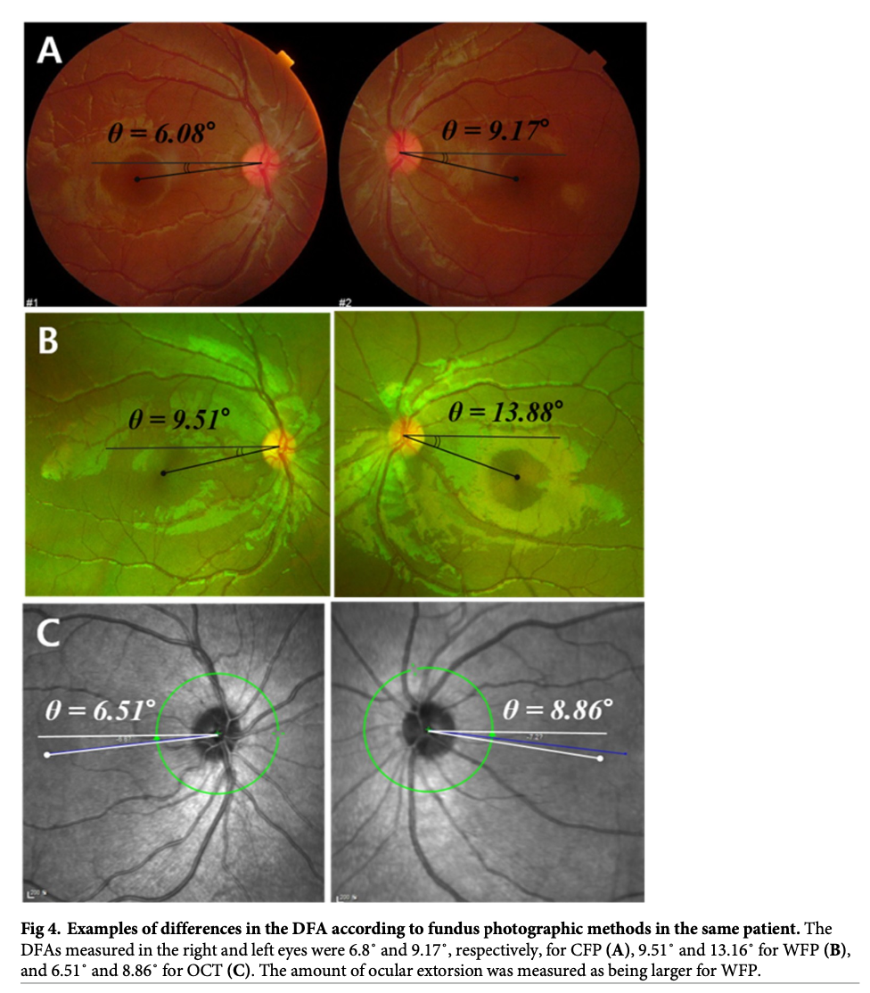 Figure: Several methods of retinal imaging, including: conventional fundus photography (panel A), wide-angle fundus photography (panel B) and optical coherence tomography (panel C).  From Range et al. (2020).