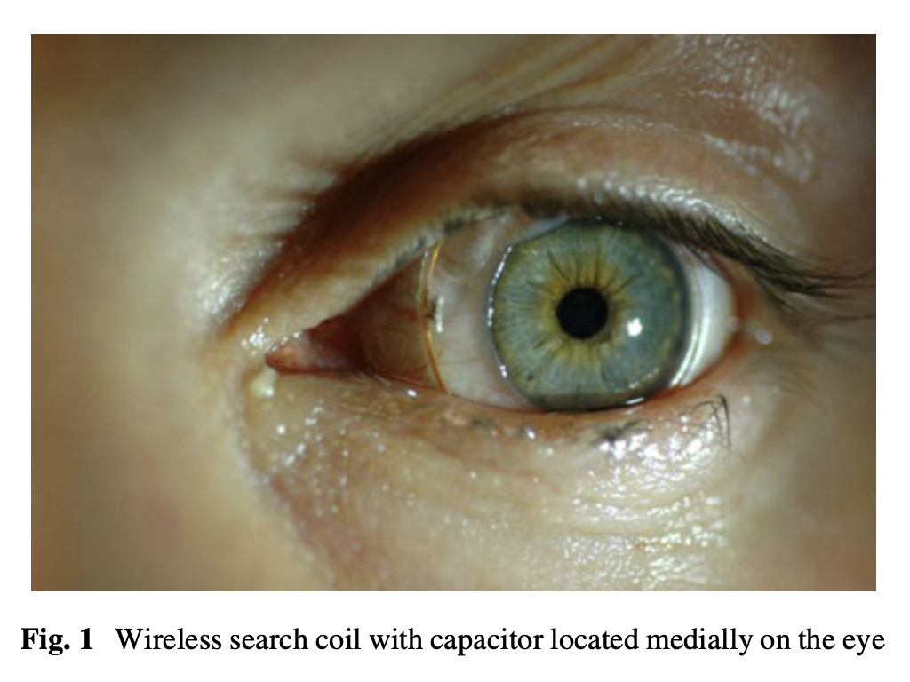 Figure: Wireless search coil with capacitor located on the side of the medial cantos.  From Scherer et al. (2011).