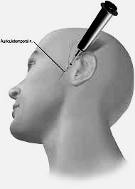 Figure: Location of blockade for auriculotemporal neuralgia.  From Levin (2010).
