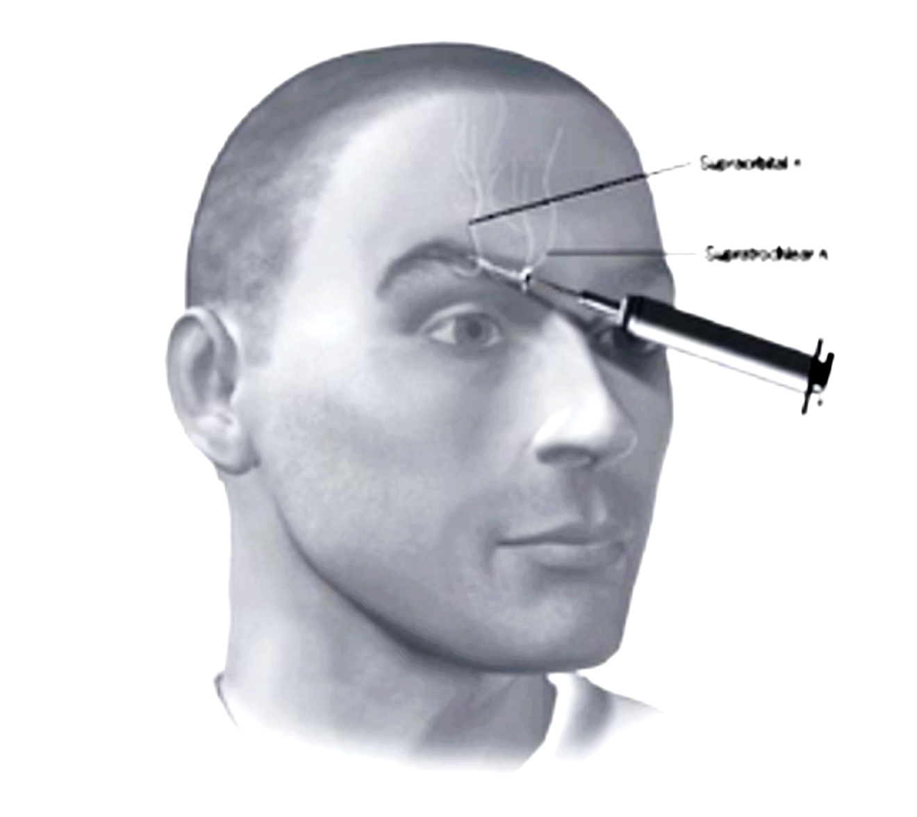 Figure: Location of blockade for supraorbital and supratrochlear neuralgia.  From Levin (2010).