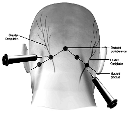 Figure: Location of blockade for occipital neuralgia.  From Levin (2010).